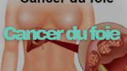 Cancer du Foie