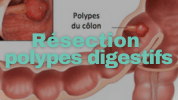 Résection polypes digestifs Dr Lahbabi Mounia Gastro Fès