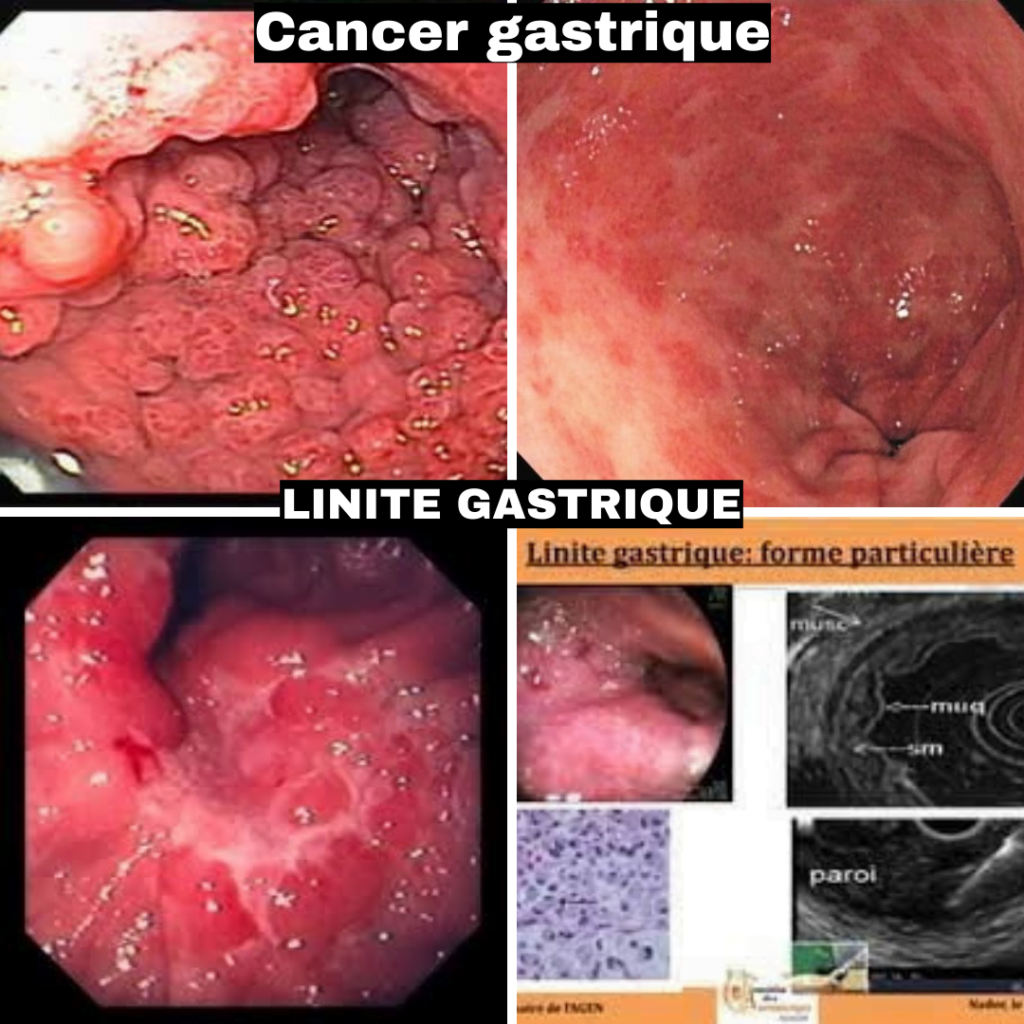 Cancer gastrique dr lahbabi Mounia cancer gastrique helicobacter pylori cancer gastrique traitement cancer gastrique cause