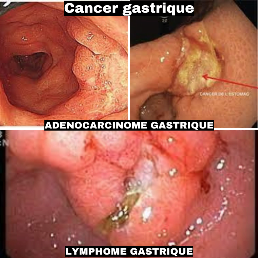 Cancer gastrique gastro fes cancer gastrique symptômes cancer gastrique traitement cancer gastrique helicobacter pylori