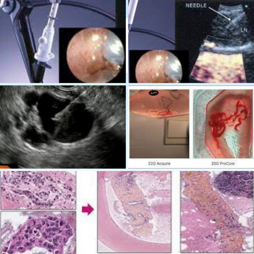 Cytoponction sous échoendoscopie digestive