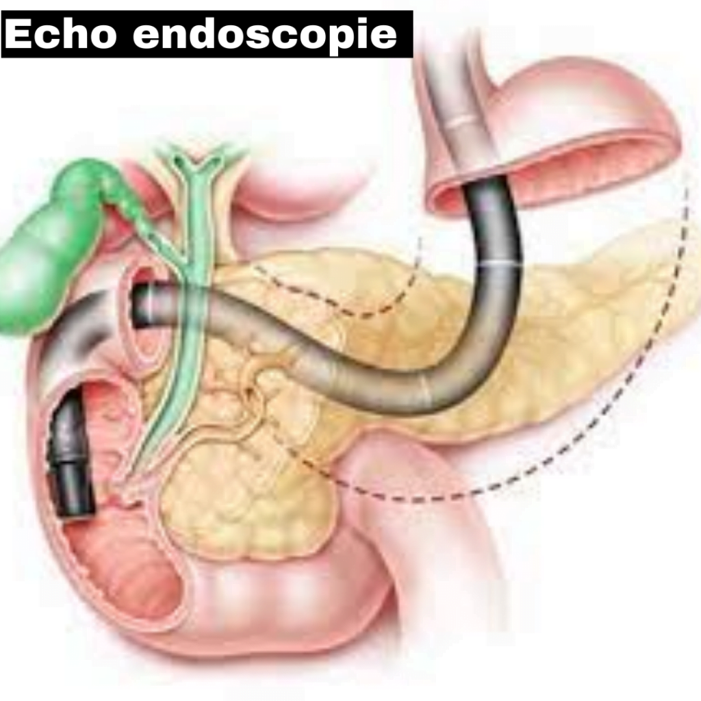 Echo endoscopie echo endoscopie pancréas echo endoscopie biliaire echo endoscopie rectal echo endoscopie digestive echo endoscopie prix maroc