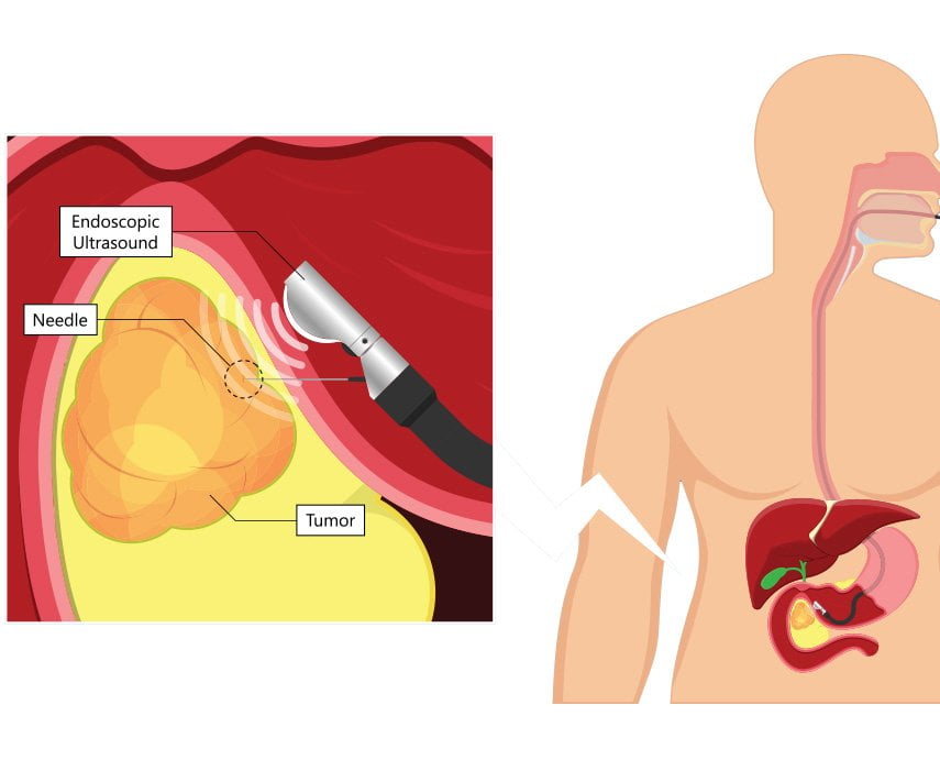 Cytoponction sous échoendoscopie digestive. Gastro fes. Gastroenterologue à fes. Fibroscopie. Fibroscopie fes. Coloscopie. Coloscopie fes. Hepato à fes. Procto. Procto fes. Echographie fes. Helicobacter pylori. Helicobacter pylori fes. Mici fes. Ponction liquide d ascite fes. Hepatite fes. Cirrhose fes. Steatose fes. Hemorroide fes. Ligature hemorroides fes. Fissure anale fes. Abces anale fes. Diarrhée fes. Vomissement fes. Douleurs abdominale fes. Hypnose fes. Biopsie hepatique fes. Echodoppler fes. Fibroscan fes. Anemie fès