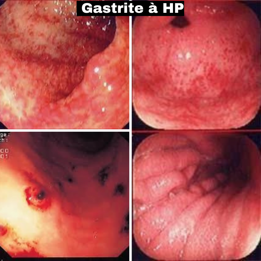 gastro entérologue autour de moi Lésions endoscopiques Gastrite à HP dr lahbabi mounia fes gastrite à gastro entérologue fes