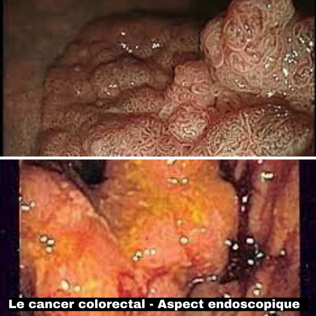 Aspect endoscopique le cancer colorectal colorectal 30 ans