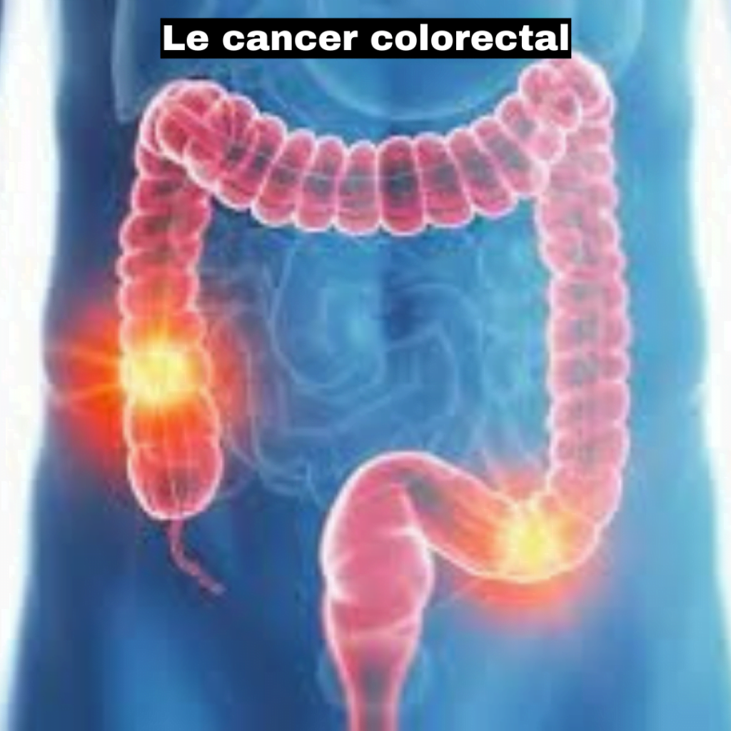 le Cancer Colorectal le cancer colorectal fes le cancer colorectal c'est quoi le cancer colorectal symptomes le cancer colorectal touche plus les hommes le cancer colorectal est il mortel le cancer colorectal touche en majorité les hommes