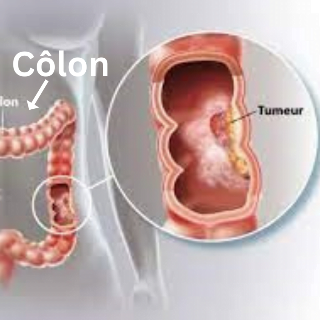 Le cancer colorectal cancer du côlon cancer du côlon symptômes