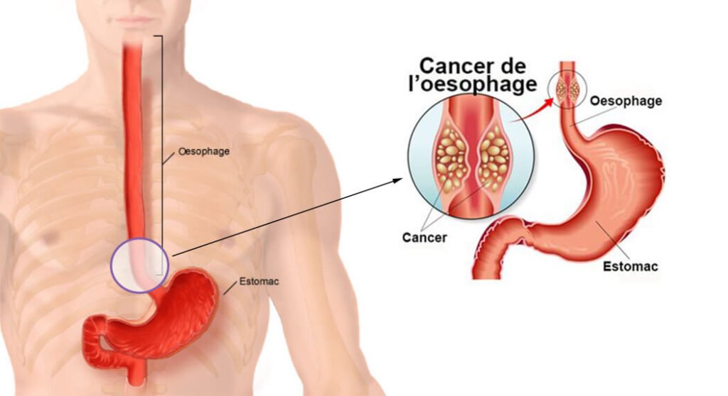 l'œsophage et du cardia Le Cancers de l’œsophage et du cardio