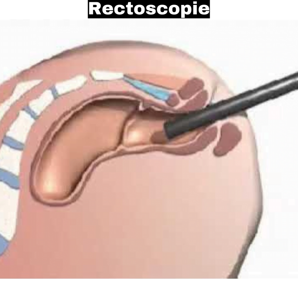 rectoscopie prix maroc Rectoscopie rectoscopie rigide rectoscopie et coloscopie endoscopie