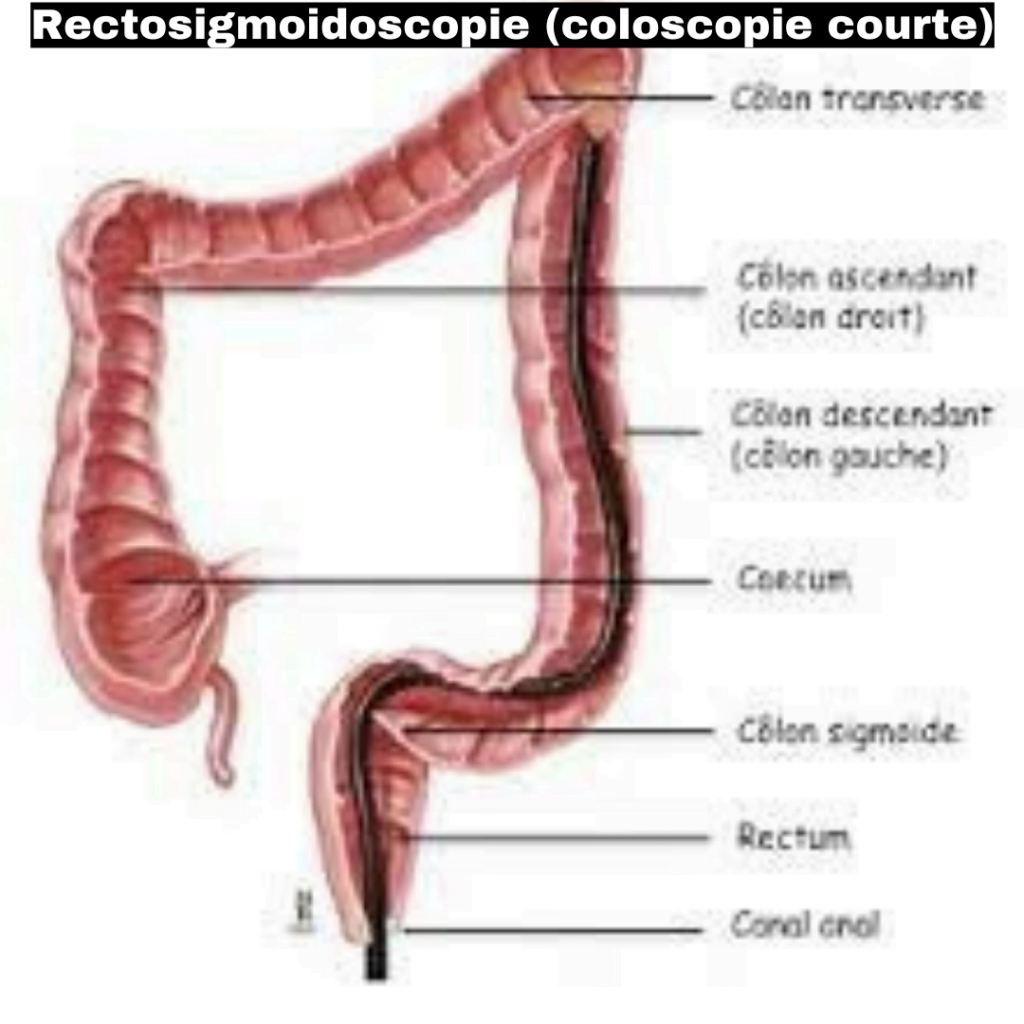 rectosigmoïdoscopie coloscopie courte rectosigmoïdoscopie douleur rectosigmoïdoscopie prix maroc rectosigmoïdoscopie à jeun