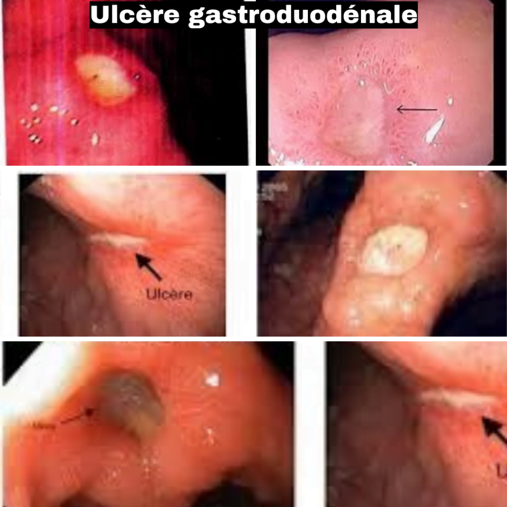 Ulcère gastroduodénale gastro fes ulcère gastro duodénal ulcère gastro duodénal définition ulcère gastrique ulcère gastroduodénal symptomes ulcère gastroduodénal traitement ulcère gastroduodénal cause