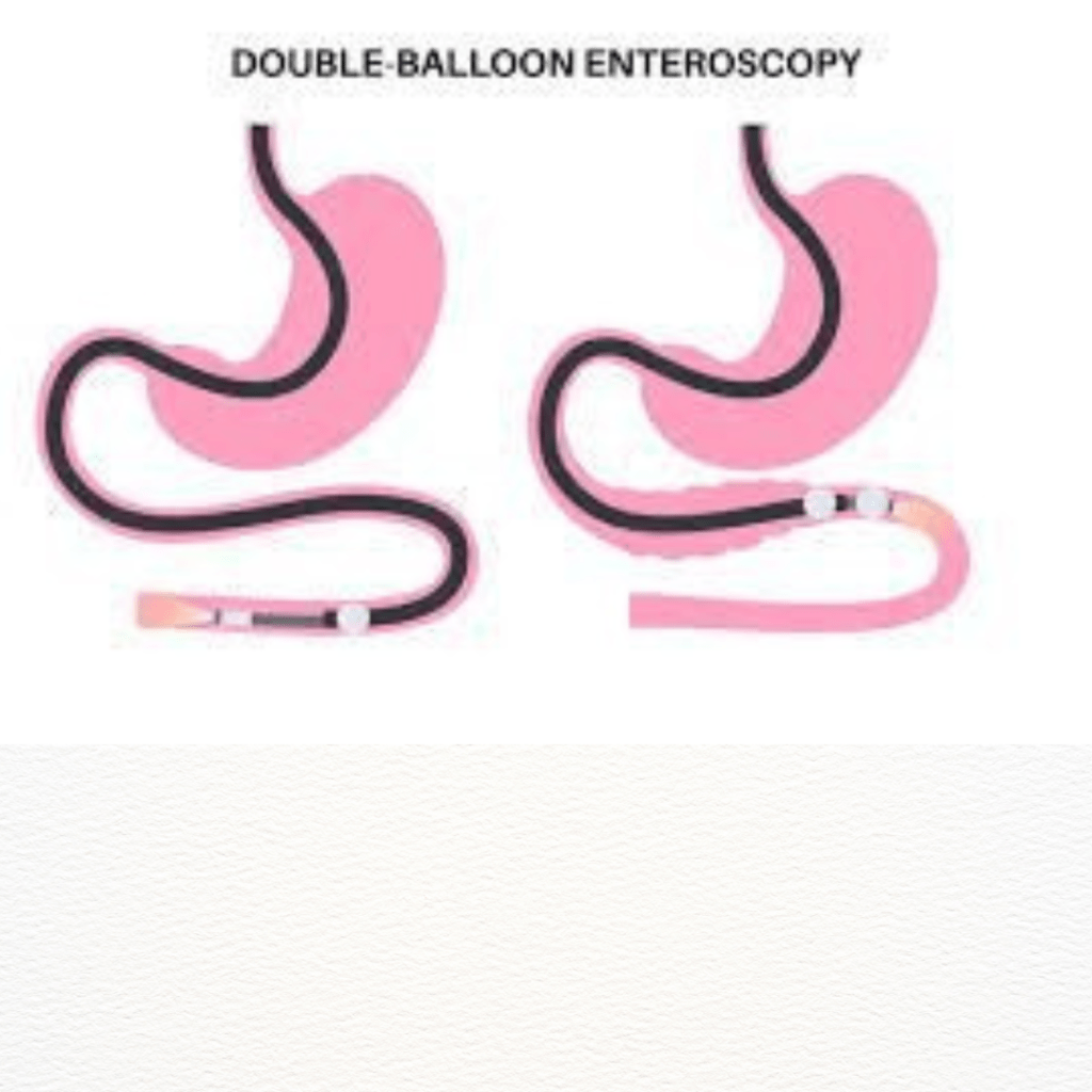 double balloon endoscopy double balloon endoscopy preparation double balloon endoscopy procedure double balloon endoscopy fes double balloon endoscopy fes prix